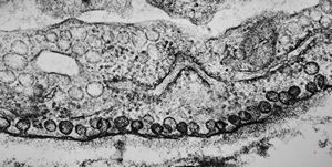 M,22y. | pinocytotic vesicles in the endothelial cell